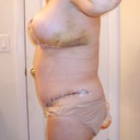 Five days post op, mommy makeover, side