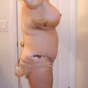 Five days post op, mommy makeover, side