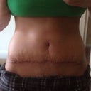 13 days.....  Scar seems too high