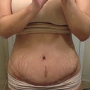 Doctor said that scar will turn bright red before it fades . my most stubborn part is lower stomach when it comes to swelling , inscition  feels like a dam.