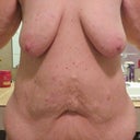 Pre-Surgery - full front view of breasts and abdomen