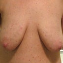 Pre-Surgery - front view of sagging girls
