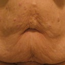 Pre-Surgery - Front view of abdomen