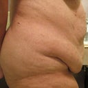 Pre Surgery - Side view of abdoment
