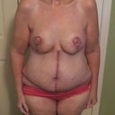 Post surgery - full front view 10 days PO