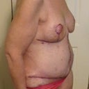 Post sugery - 45 degree view 10 days PO