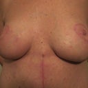 Post Surgery - breasts 8 weeks PO - notice the nice midline incison
