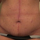 Post surgery - abdoment 8 weeks PO - the incisions are looking very nice!