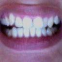 Another before picture.  No Invisalign, no extraction.