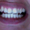 This was after I had my tooth extracted and after one tray of Invisalign.