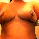 8 days post-op