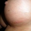 Left Breast