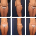Preop on top, 2 months post op on bottom