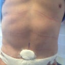 2 days post-op