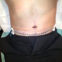 4 days post-op