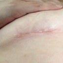 4 wk scar