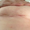 4 wk scar
