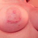5 weeks, I'm prone to keloids so the scar is worrying me