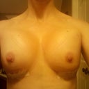 Post-op: Day 3