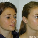 Rhinoplasty Patient