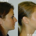 Rhinoplasty Patient