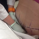 PO Day 1
360 Incision