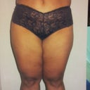 BEFORE SMARTLIPO!!!
