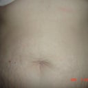 2days before surgery, close up of my tummy