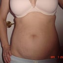 2days before surgery, front view