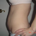 2days before surgery, side view