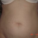 2days before surgery, front view