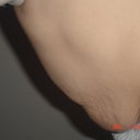 2days before surgery, leaning forward (side view)