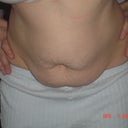 2days before surgery, leaning forward