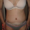2wks post op morning, does this seem like a normal amount of swelling?