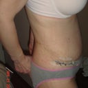 2wks post op morning side view