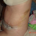 4 days after surgery