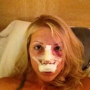 Day 2 - My eyes look crazy swollen. My dad was making fun of my "santa clause" mustache gauze, haha.
