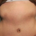 tummy tuck 6 months post-op.