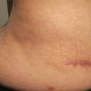 lipo area 6 months post-op