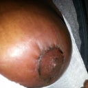 This is the right breast. Very itchy, swollen and inflamed