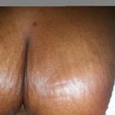 Looks like whelts or scratches. I havent scratched at all and this is what they look like. Verrryy itchy.
