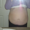 front view pre surgery