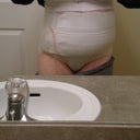 front view 8 days post op