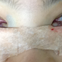 immediately post op