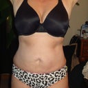 2 MONTHS 1 DAY POST OP