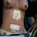 post op day 1. he said that my diastis recti was huge, about 4-6 inches in width!!!