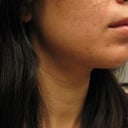 This is my post ipl skin. I'm lucky that I didn't get burned on the skin, but my dermis was overheated and the dermis does not regenerate. I went from clear and smooth, to this:(.