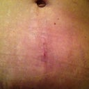 4 week vertical old belly button scar--barely noticeable