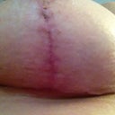 4 week breast incision