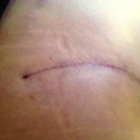 4 week side incision view